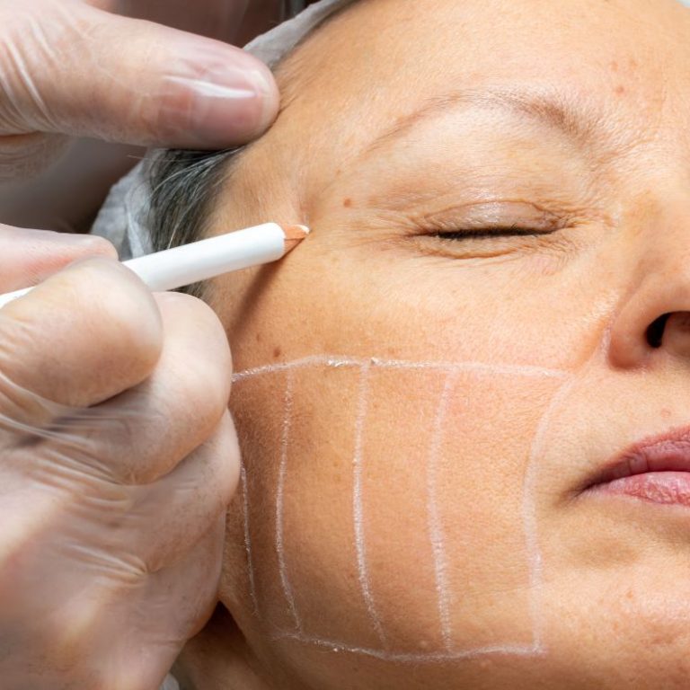 HIFU FACIAL BARCELONA