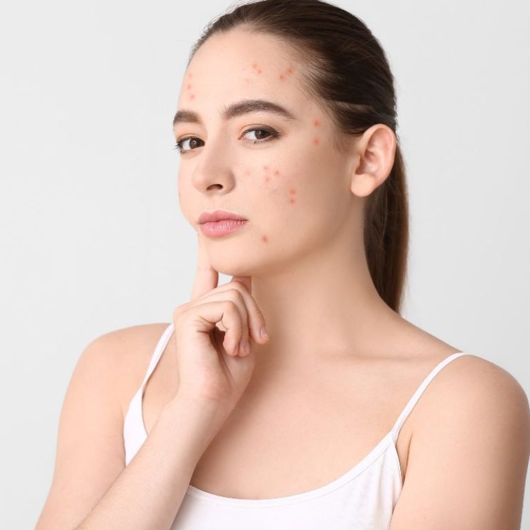 Tratamientos Anti-Acné yume barcelona