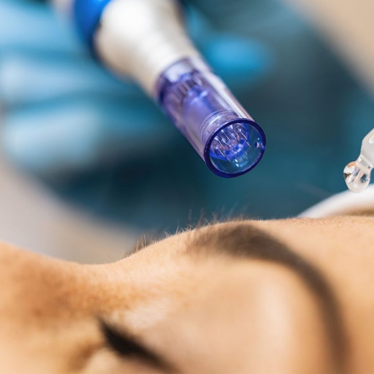 microneedling en barcelona ¿Qué es el Microneedling y Por Qué Está Revolucionando el Cuidado de la Piel